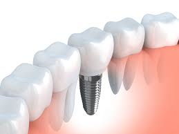 Read more about the article Dental Implants Procedure and Benefits