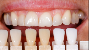 Read more about the article Use These 4 Easy Home Remedies For Teeth Whitening
