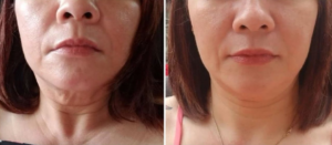 Read more about the article Benefits of LED Light Therapy for Your Skin