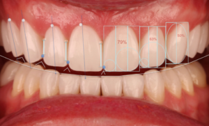 Read more about the article Basic Tips For Choosing A Great Dentist For Veneer Composite