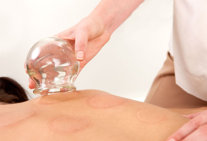 You are currently viewing Cupping Therapy In Wellington: An Ancient Healing Practice