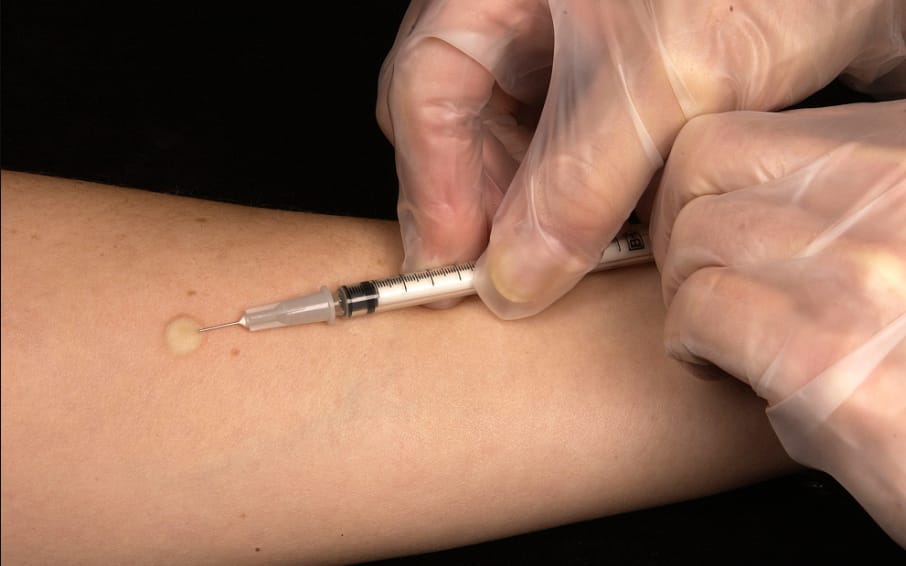 Read more about the article Tuberculin Skin Test In Edmonton – How It Works?