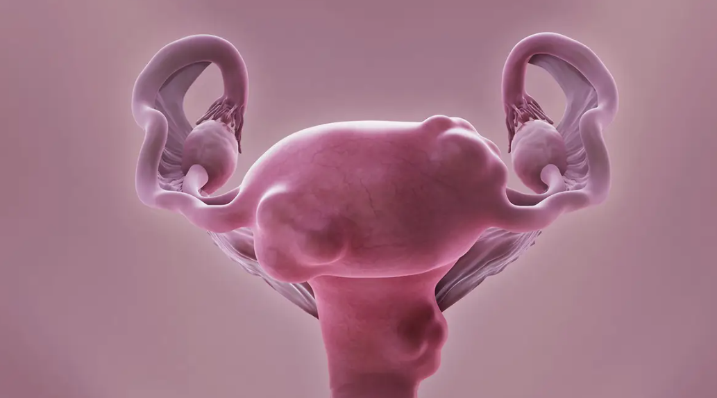 You are currently viewing A Gentler Approach: The Benefits of Uterine Artery Embolization