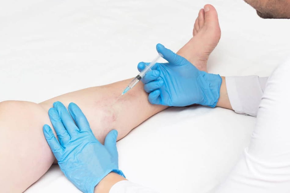 You are currently viewing After Care Tips for Vein Injection Sclerotherapy