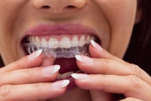Invisalign treatment